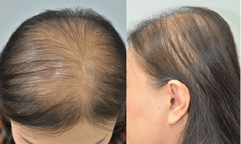 Calvície ou alopecia
