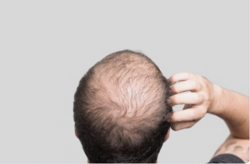 O que é calvície ou alopecia?
