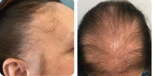 Alopecia ou Calvície